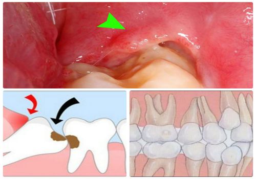 Răng khôn gây ra những biến chứng bất thường cho con người