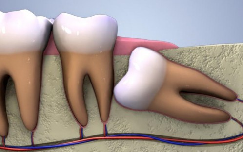 Mọc răng khôn sưng lợi là một trong những biểu hiện của răng số 8 mọc lệch