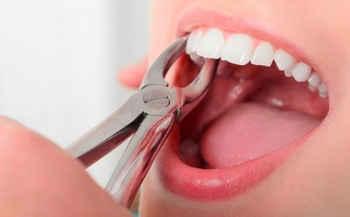 Nhổ nhiều răng khôn cùng lúc dễ dẫn đến mất máu, đau hàm