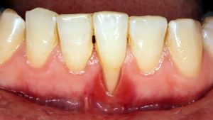 Cách điều trị u răng