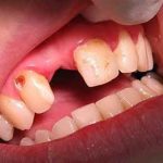 7 Mẹo trị sâu răng tại nhà hiệu quả tức thì